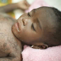 Complications of measles include blindness, deafness, brain damage and death